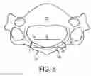 Fig. 09 - Lamina implants and methods for spinal decompression