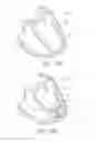 Fig. 43 - Systems and methods for improving cardiac function