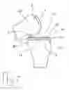 Fig. 08 - SYSTEM AND METHOD FOR SIDE INSERTION OF A BICONDYLAR MINI KNEE IMPLANT