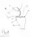 Fig. 09 - SYSTEM AND METHOD FOR SIDE INSERTION OF A BICONDYLAR MINI KNEE IMPLANT