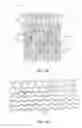 Fig. 06 - Uncaging stent