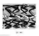 Fig. 65 - Uncaging stent