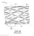 Fig. 79 - Uncaging stent