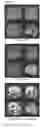 Fig. 10 - Estrogen therapy for brain gray matter atrophy and associated disability