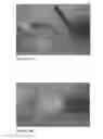 Fig. 05 - One component fibrin glue comprising zymogens