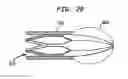Fig. 17 - Heart assist device with expandable impeller pump