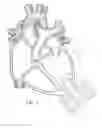 Fig. 08 - Implantable pump system having a coaxial ventricular cannula