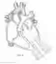 Fig. 09 - Implantable pump system having a coaxial ventricular cannula