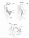 Fig. 02 - Methods for inhibiting heterotopic ossification