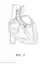 Fig. 02 - Suturing devices and methods for suturing an anatomic valve