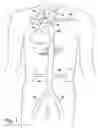 Fig. 02 - Partial aortic occlusion devices and methods for cerebral perfusion augmentation