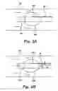 Fig. 03 - Partial aortic occlusion devices and methods for cerebral perfusion augmentation