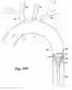 Fig. 30 - Partial aortic occlusion devices and methods for cerebral perfusion augmentation
