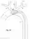 Fig. 32 - Partial aortic occlusion devices and methods for cerebral perfusion augmentation