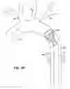Fig. 34 - Partial aortic occlusion devices and methods for cerebral perfusion augmentation