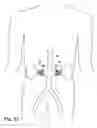 Fig. 35 - Partial aortic occlusion devices and methods for cerebral perfusion augmentation