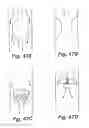 Fig. 46 - Partial aortic occlusion devices and methods for cerebral perfusion augmentation