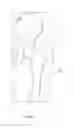Fig. 04 - Patient-specific total hip arthroplasty