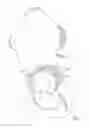 Fig. 09 - Patient-specific total hip arthroplasty