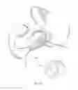 Fig. 11 - Patient-specific total hip arthroplasty