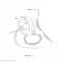 Fig. 13 - Patient-specific total hip arthroplasty