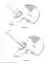 Fig. 17 - Patient-specific total hip arthroplasty