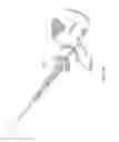 Fig. 18 - Patient-specific total hip arthroplasty