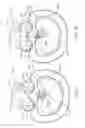 Fig. 09 - Interspinous process device and method