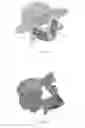Fig. 04 - Pars Interarticularis Fracture Device