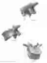 Fig. 09 - Pars Interarticularis Fracture Device