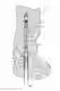 Fig. 02 - Arthrodesis devices for generating and applying compression within joints