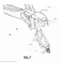 Fig. 06 - Distraction and compression in one plier