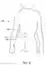 Fig. 13 - Skeletal manipulation method