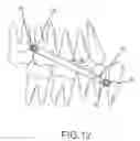 Fig. 12 - ORTHODONTIC APPLIANCE AND METHOD FOR CLASS II AND CLASS III MALOCCLUSION AND DENTAL ASYMMETRIC CORRECTION