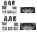 Fig. 16 - ORTHODONTIC APPLIANCE AND METHOD FOR CLASS II AND CLASS III MALOCCLUSION AND DENTAL ASYMMETRIC CORRECTION