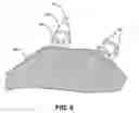 Fig. 06 - Mesh for Hiatal Hernia Repair and Deployment Device