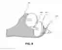 Fig. 07 - Mesh for Hiatal Hernia Repair and Deployment Device