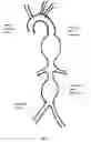Fig. 02 - STENT GRAFT DEVICE