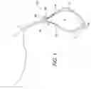 Fig. 02 - Adjustable suture button construct