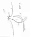 Fig. 04 - Adjustable suture button construct