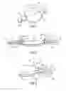 Fig. 02 - Multicomponent intraocular lens