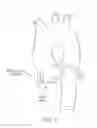 Fig. 02 - Personalized aortic valve prosthesis
