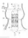 Fig. 01 - Methods for quickly implanting a prosthetic heart valve
