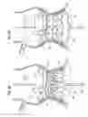 Fig. 06 - Methods for quickly implanting a prosthetic heart valve