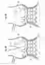 Fig. 07 - Methods for quickly implanting a prosthetic heart valve