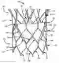Fig. 01 - Leaflet suturing to commissure points for prosthetic heart valve