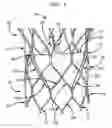 Fig. 02 - Leaflet suturing to commissure points for prosthetic heart valve