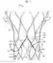 Fig. 03 - Leaflet suturing to commissure points for prosthetic heart valve