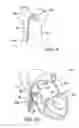 Fig. 06 - Percutaneous heart valve prosthesis