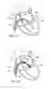 Fig. 07 - Percutaneous heart valve prosthesis